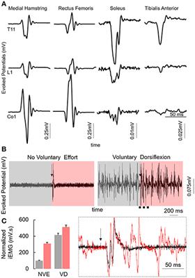 Weight Bearing Over-ground Stepping in an Exoskeleton with Non-invasive Spinal Cord Neuromodulation after Motor Complete Paraplegia